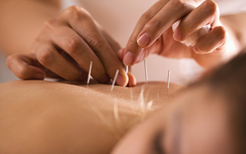 Acupuncture