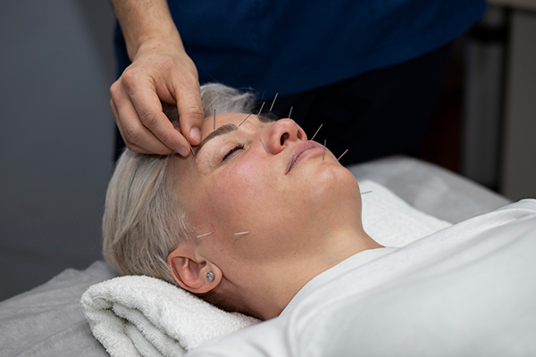 acupuncture-1